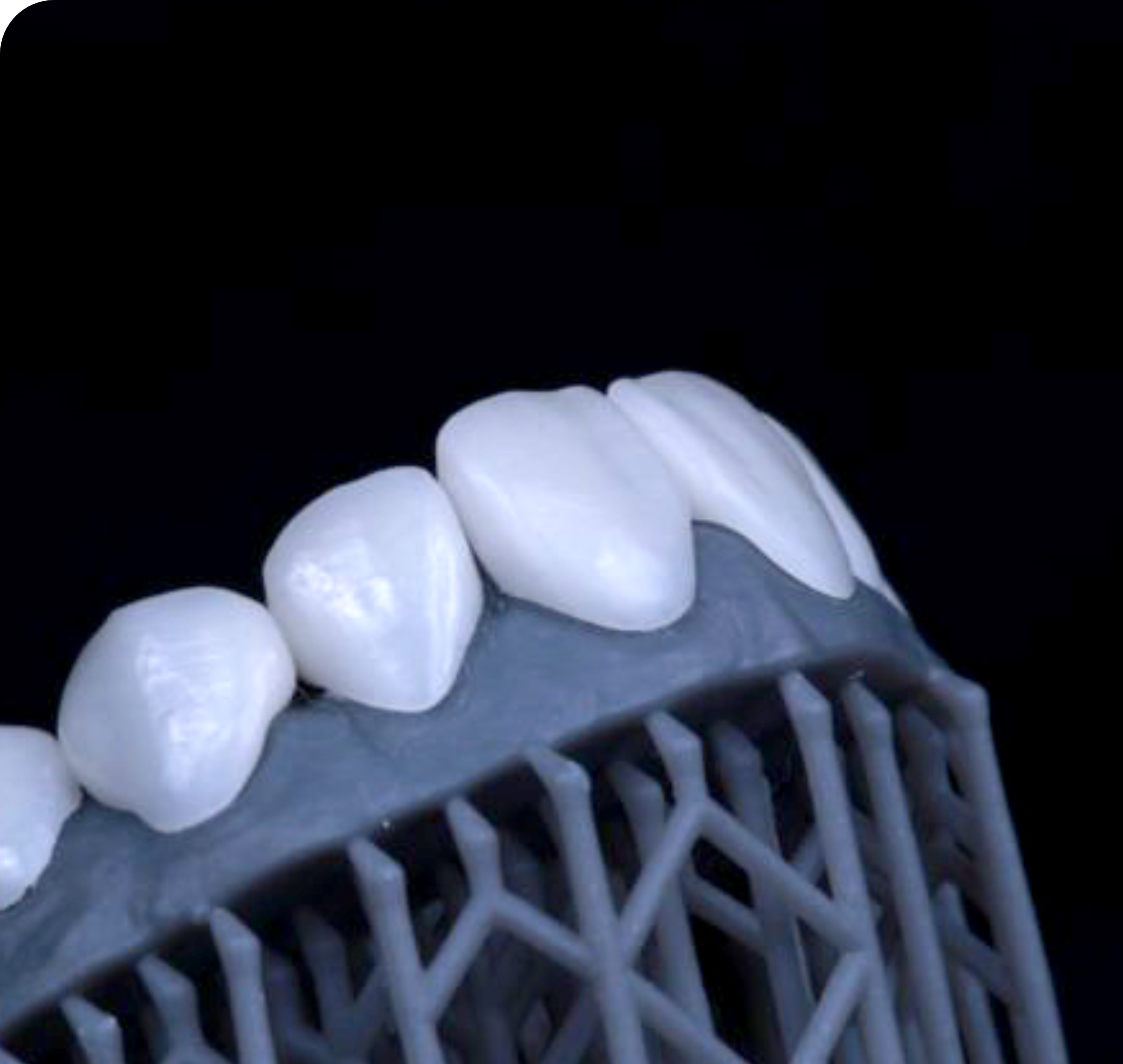 A natural-looking dental restoration created using Digital Smile Design.