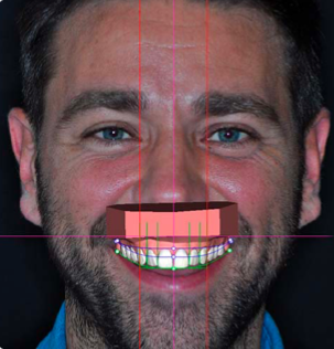 An on-screen simulation of a patient's new smile with Digital Smile Design. 